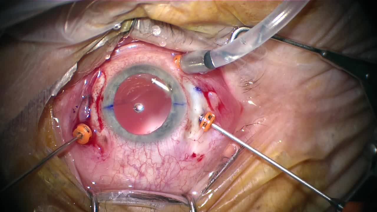 MX60 Secondary Intraocular Lens (Bausch + Lomb)