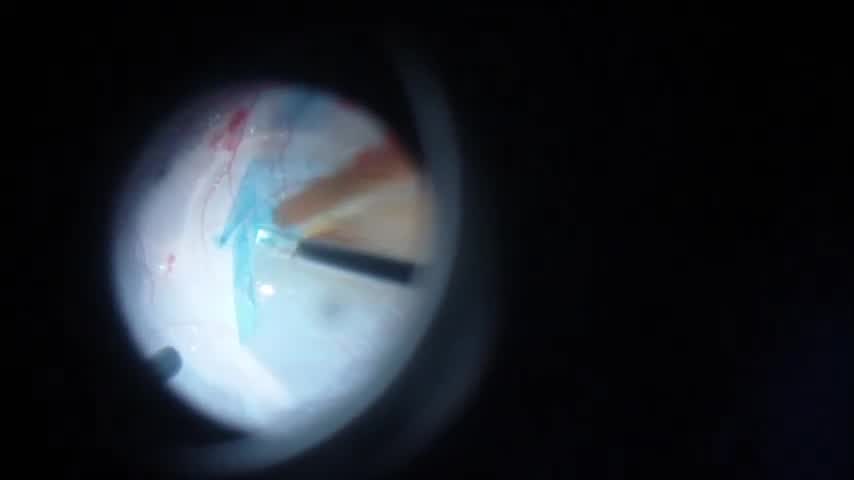 Vitrectomy surgery for Optic disc Maculopathy
