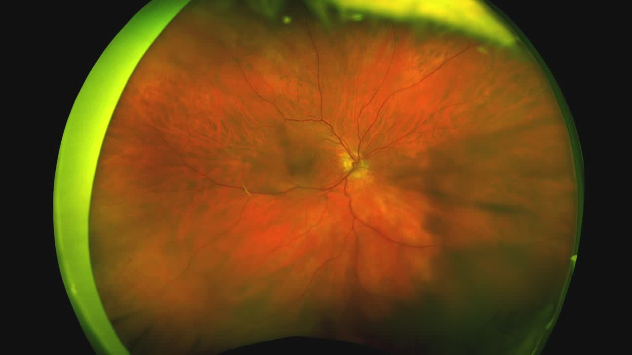 Minimal Gas Vitrectomy: Minimizing Retinal Displacement - Eyetube