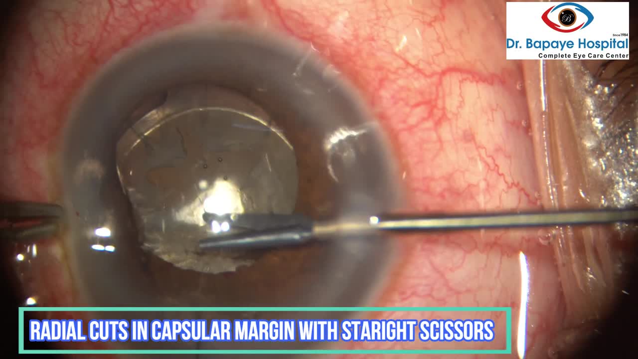 Management of Anterior Capsular Phimosis