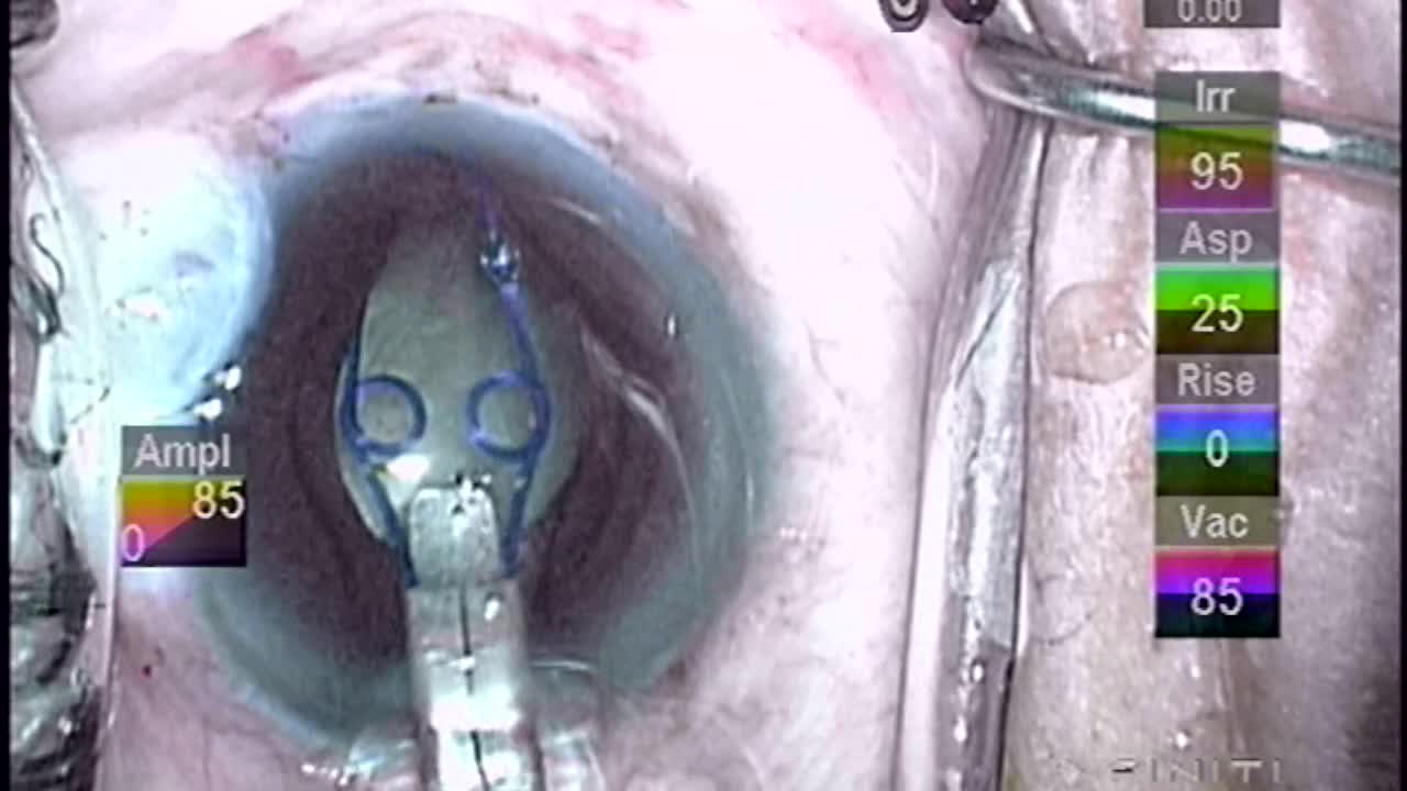 Pupillary Membranectomy with Malyugin Ring