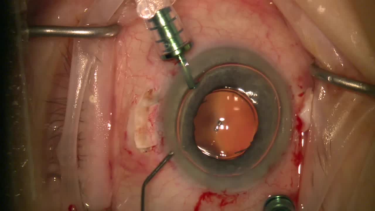 Dislocated IOL to Glued IOL