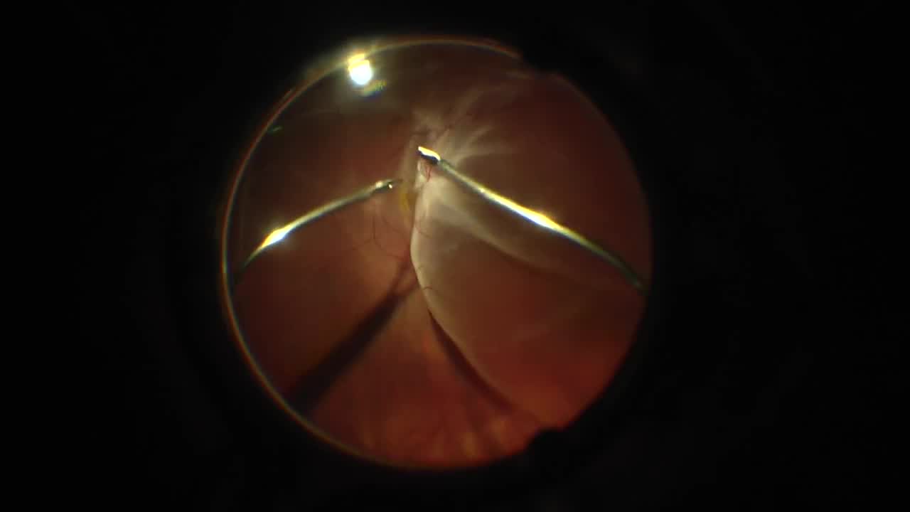 Ocular Reconstruction With PPV, TKP, PKP Pole to Pole Surgery