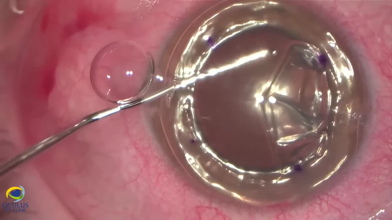 Concurrent Bi-Axial Phacoemulsification With Endo-In DMEK for Fuchs Distrophy 