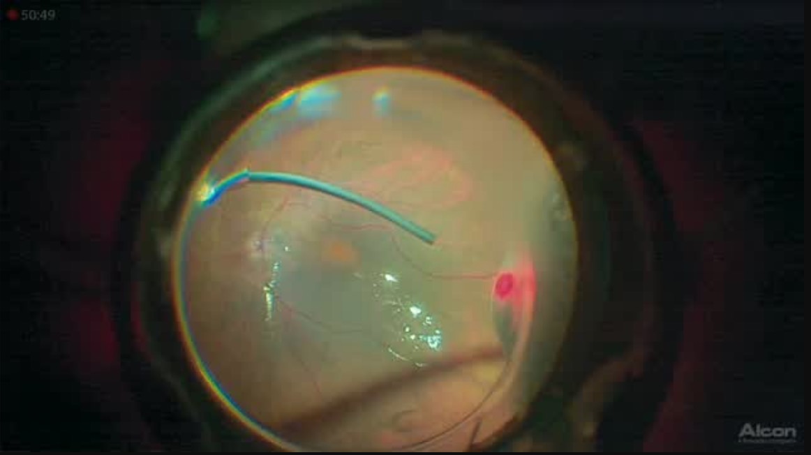 Combined PPV + Phaco in 3-D