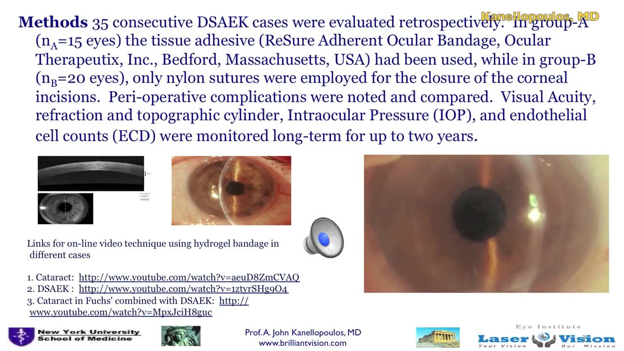 Ocular Tissue Adhesive In DSEAK Cornea Transplant: A Comparative Study