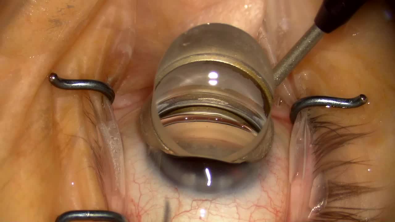 Improving Surgical Gonio View