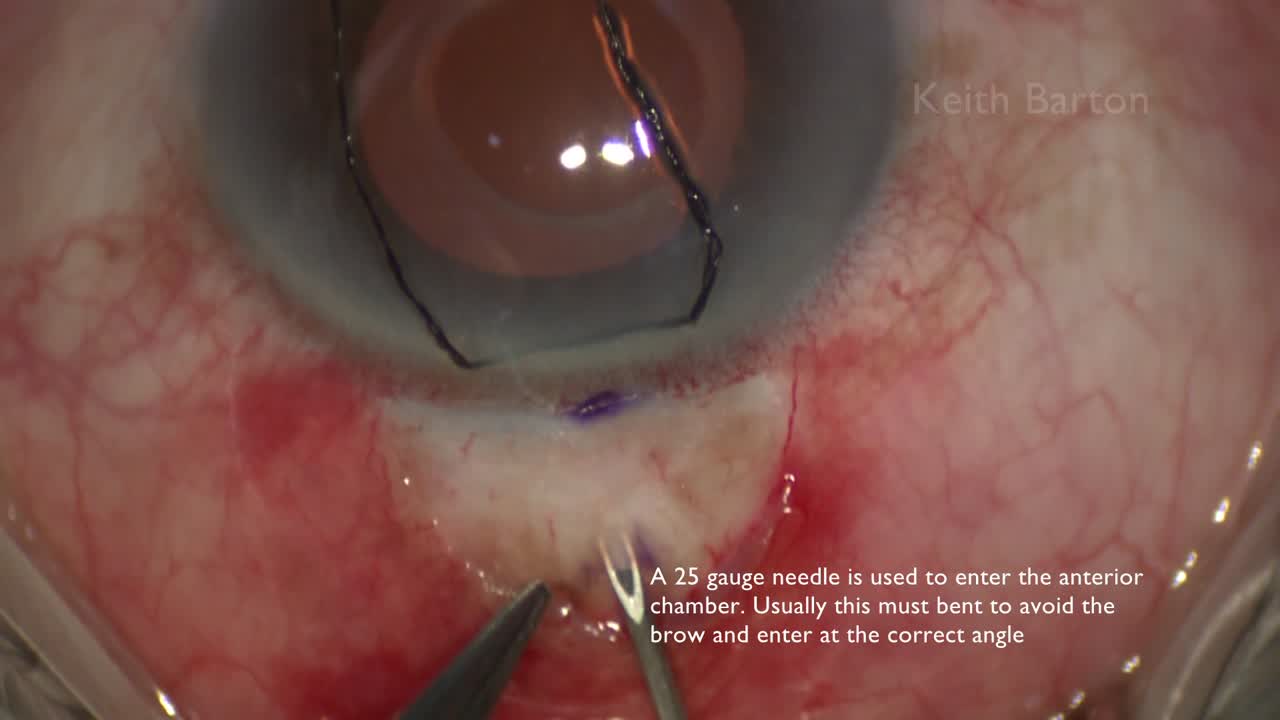 PreserFlo MicroShunt Implantation 