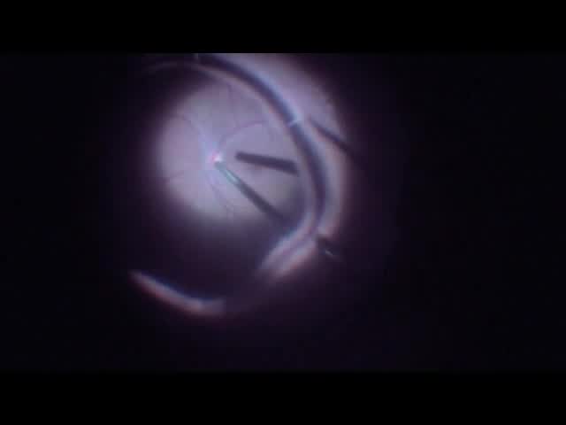 Terson's Syndrome Vitrectomy for Vitreous Hemorrhage Using the Cutter to Peel ILM