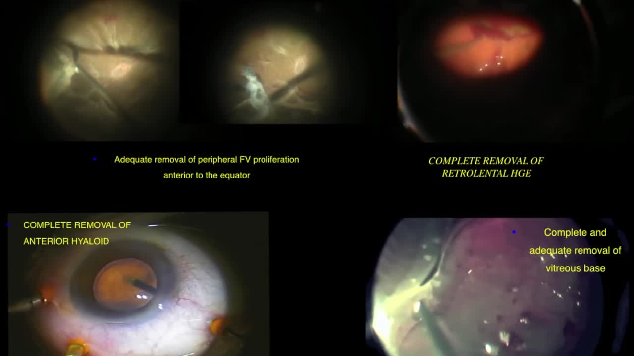 Optimizing Diabetic Vitrectomy