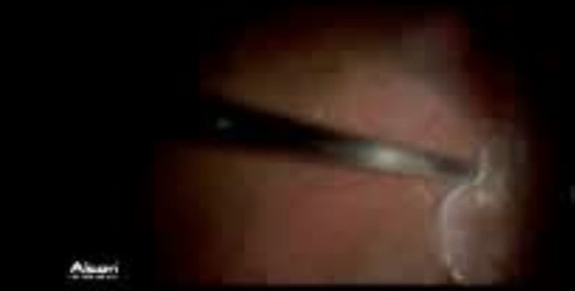 3D Diabetic VMT Surgery (iOCT Guided)