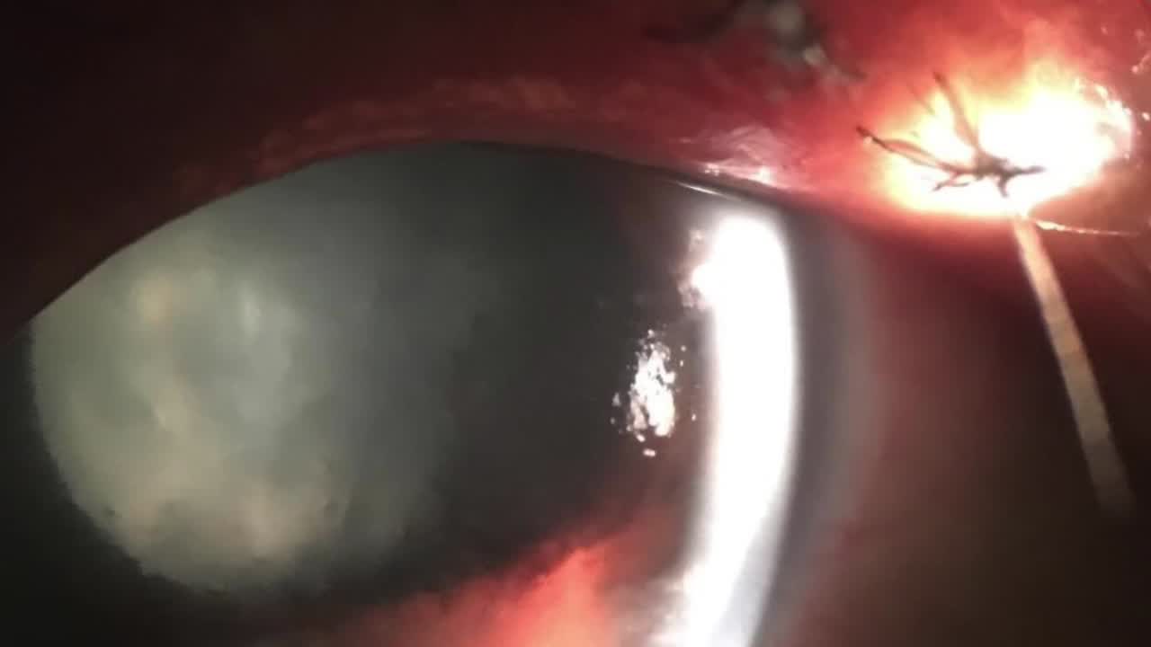 Cataract Surgery for Lens Particle Glaucoma