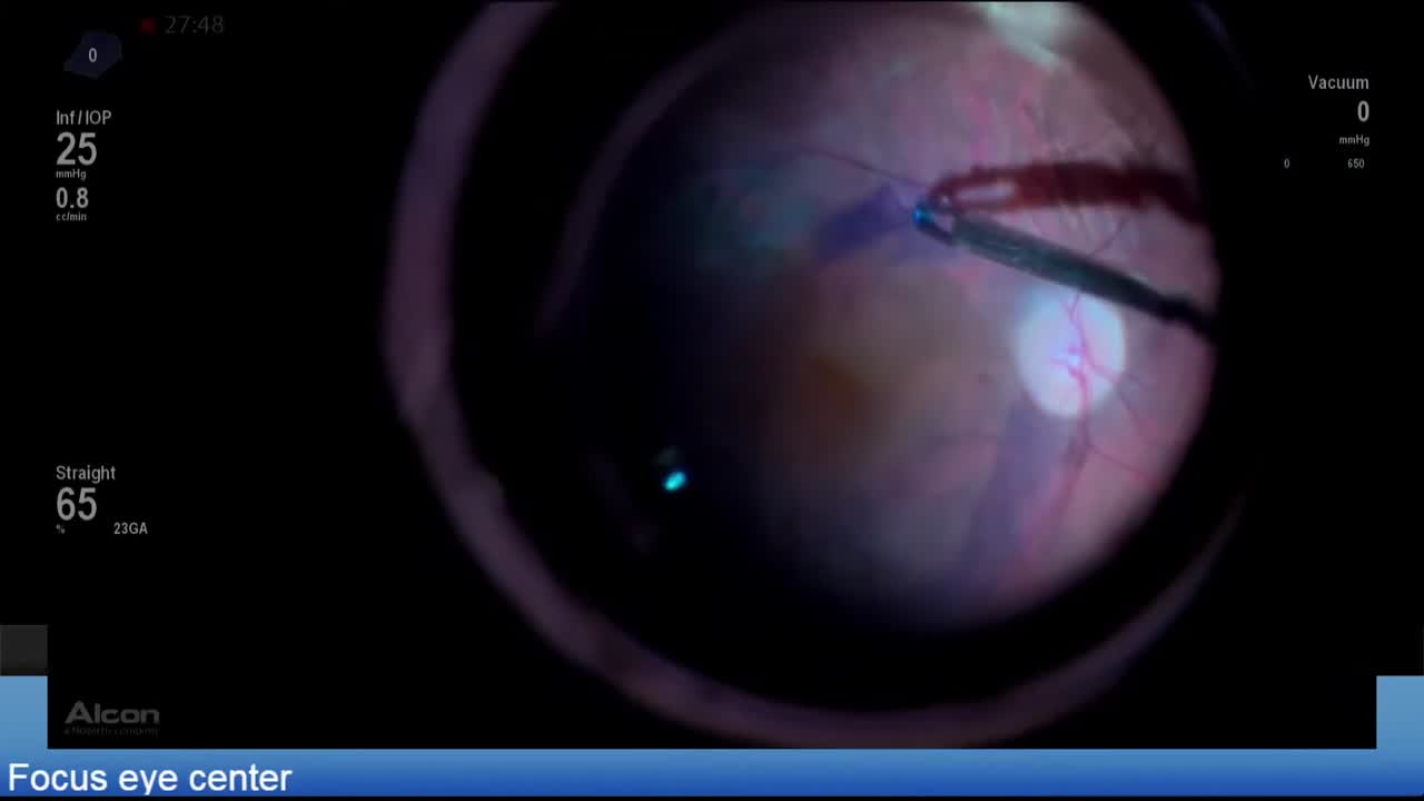 Heads-Up ILM Peel Using Air Bubble as Macular Window Lens