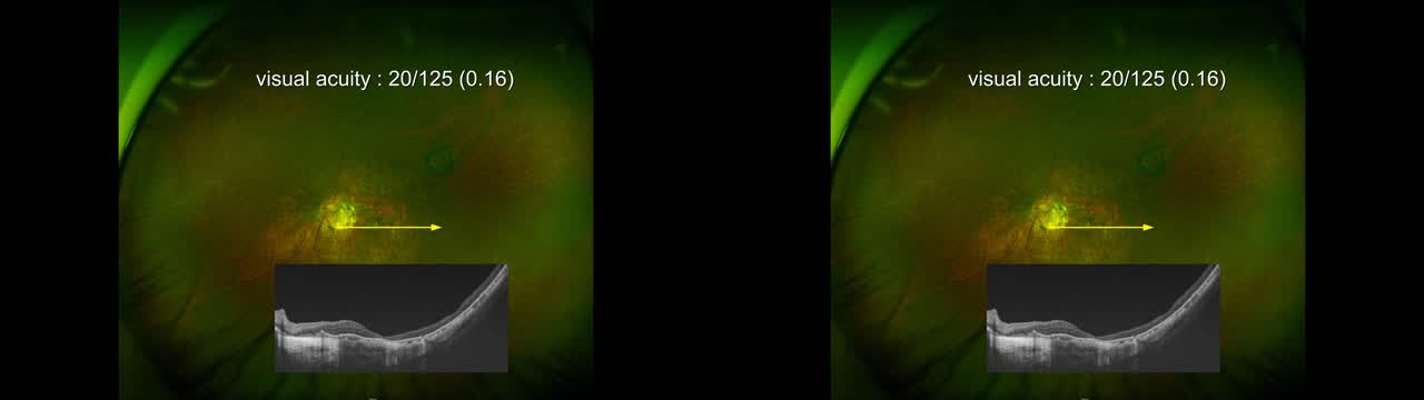 Single-Layered ILM Flap for Macular Hole Retinal Detachment