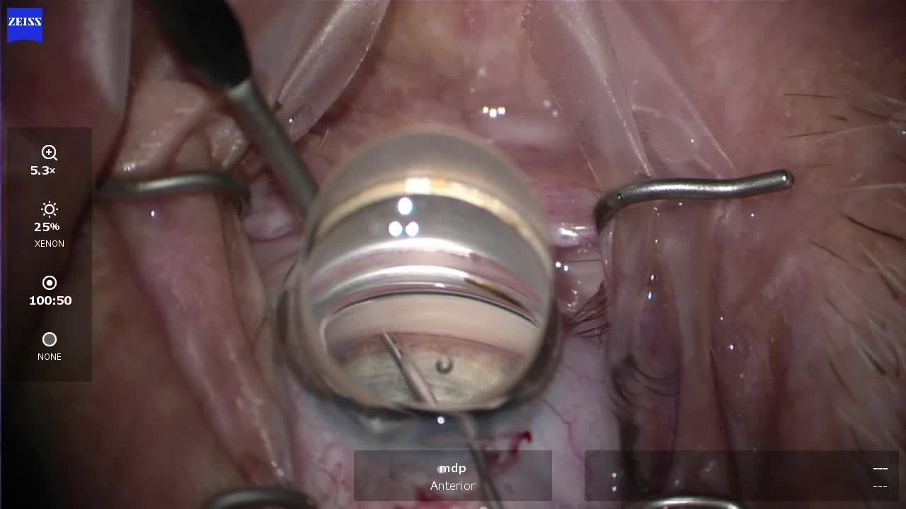 Implantation of iStent Inject W