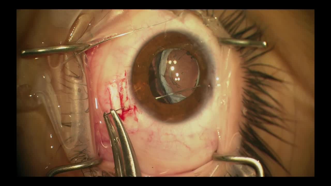 Using Capsular Fibrosis to Recenter Capsular Bags