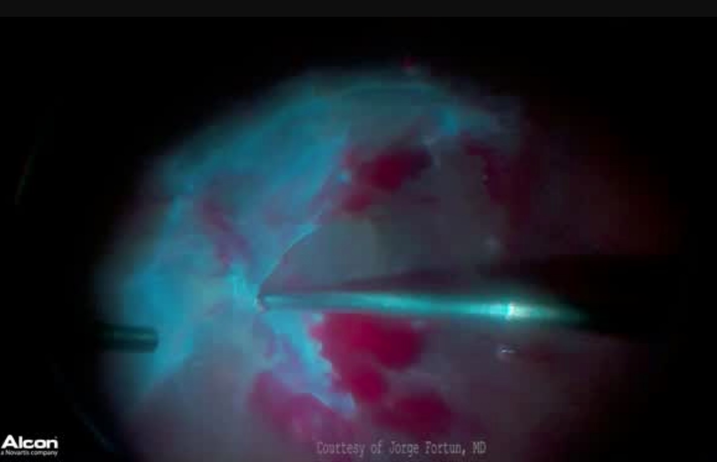 Viscodissection in TRD 3D
