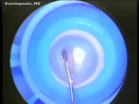 High fluency double CXL of vehicle donor cornea