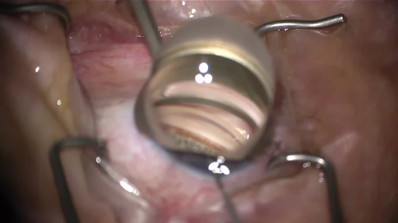 iStent Inject: Simple Yet Effective Treatment
