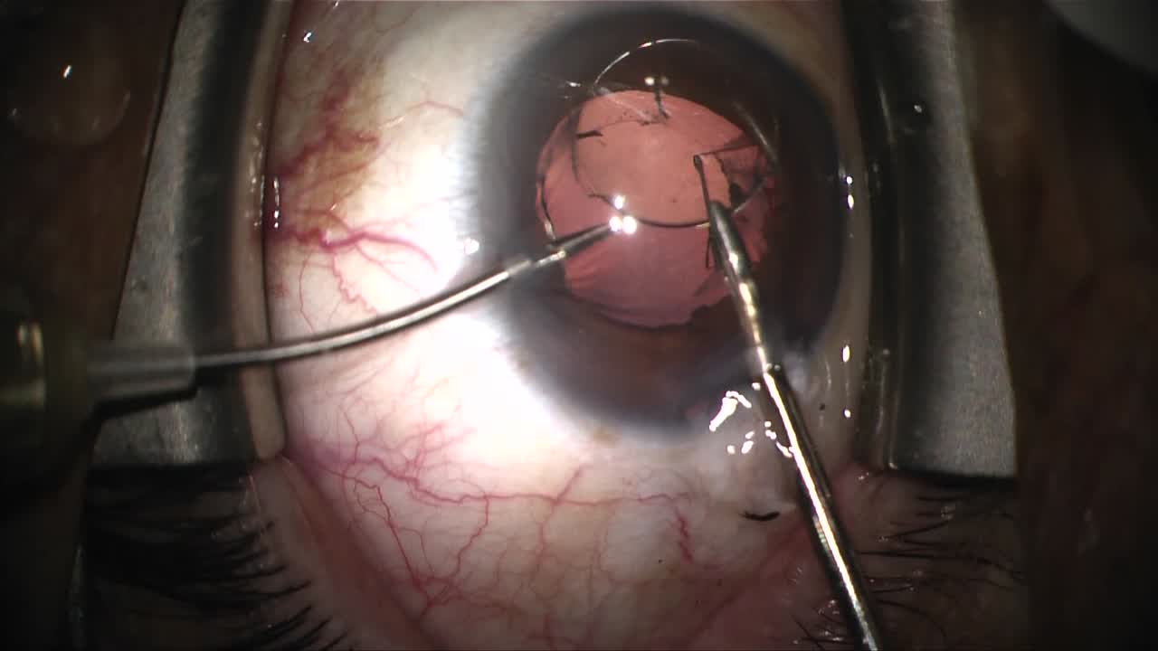 Z-Syndrome Crystalens Exchange and Repair