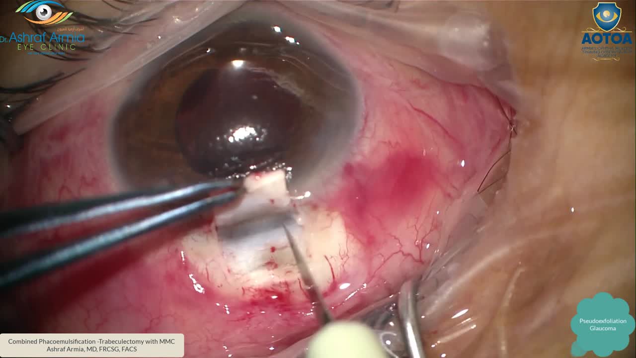 Combined Phacoemulsification and Trabeculectomy With MMC in Pseudoexfoliation Glaucoma