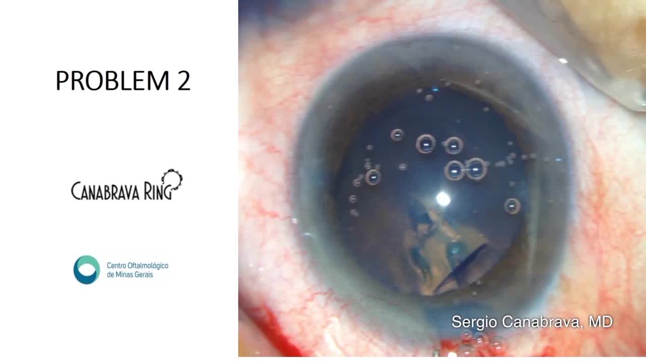 Rhexis Management - Eyetube