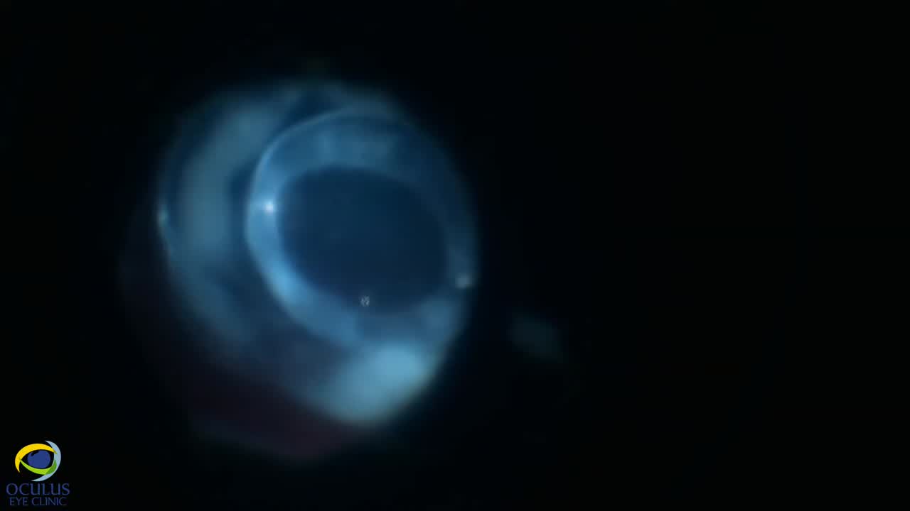 Removal of Dislocated PCIOL-Bag Complex and Scleral Suture of Akreos IOL