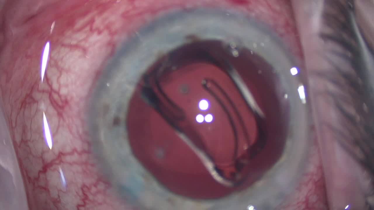 Hydrus Microstent Implantation After Routine Phacoemulsification