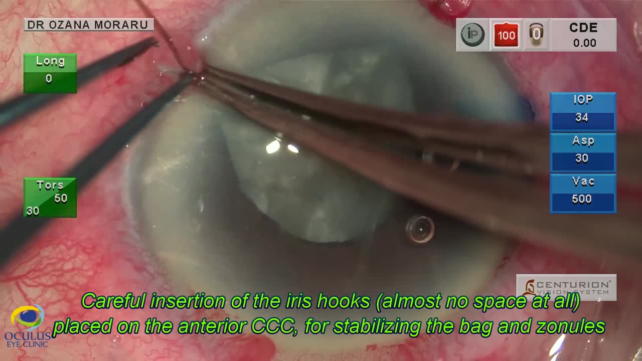 Standard Phacoemulsification for a Nonstandard Case
