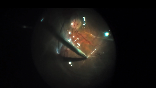 Severe Diabetic Tractional Retinal Detachment