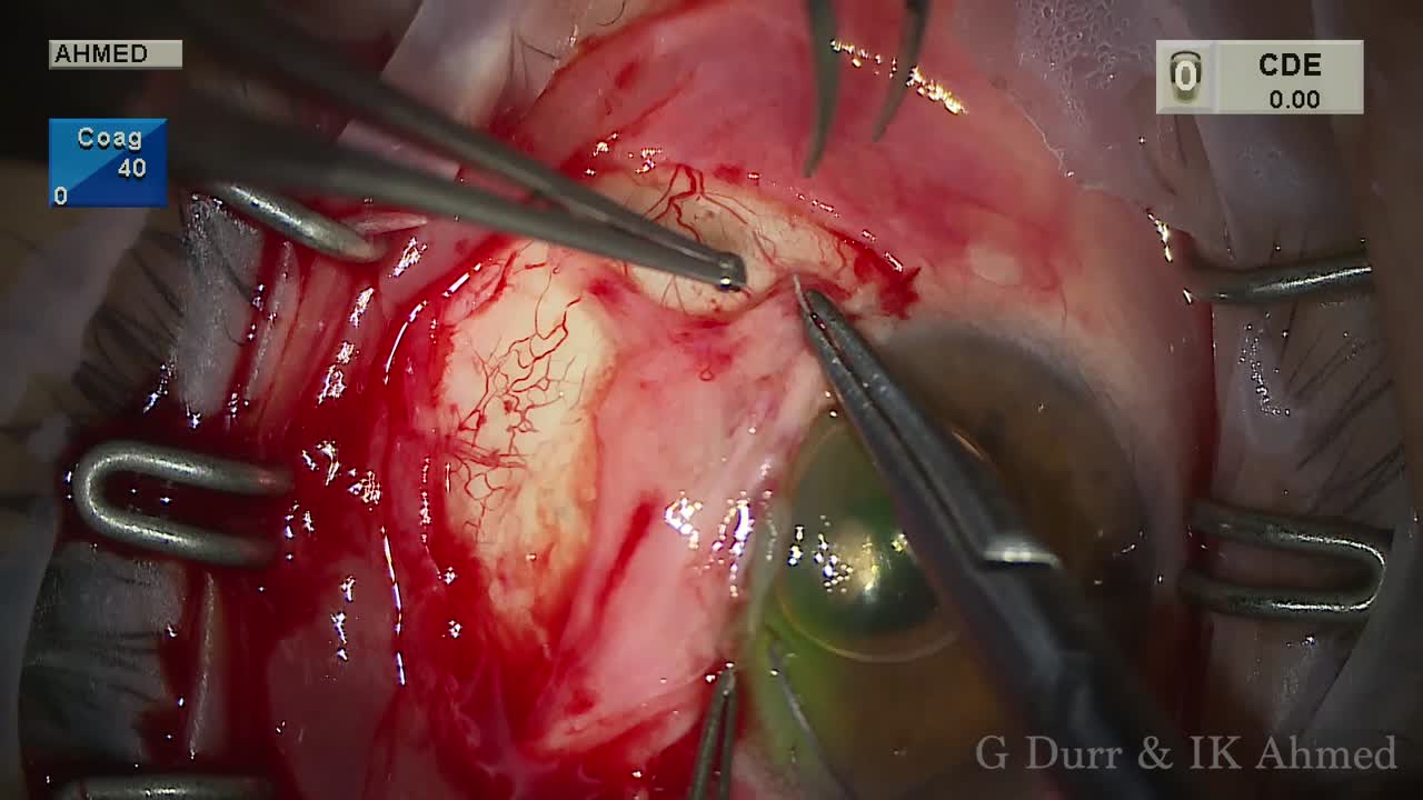 Bleb Revision for Late Leak