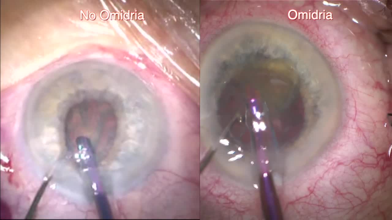 Use of Omidria Versus No Omidria