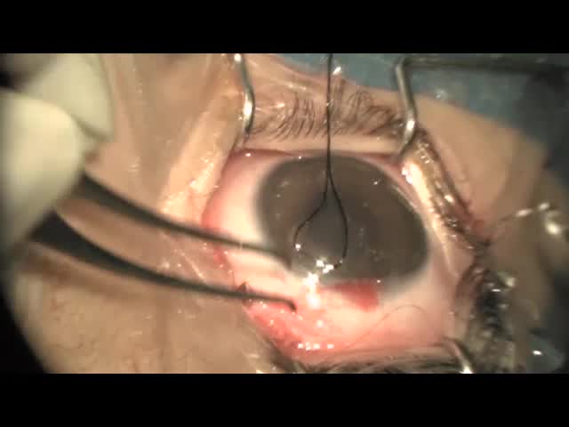 Trabeculotomy and Trabeculectomy in Congenital Glaucoma
