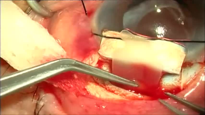 STARflo Glaucoma Implant Procedure