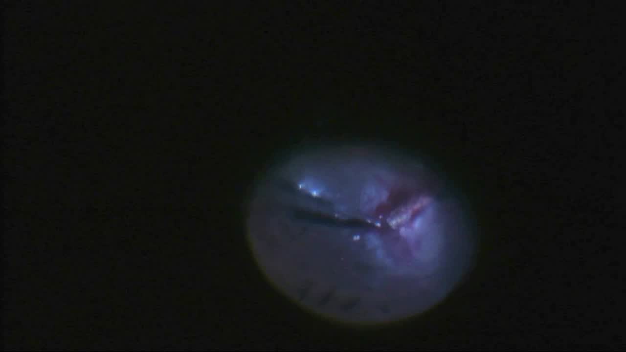 Microinvasive Foreign Body Extraction