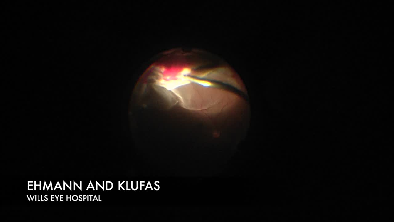 Tractional Retinal Detachment After Ruptured Globe Injury