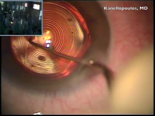 Femto-assisted Toric, Trifocal PhysIOL Implantation