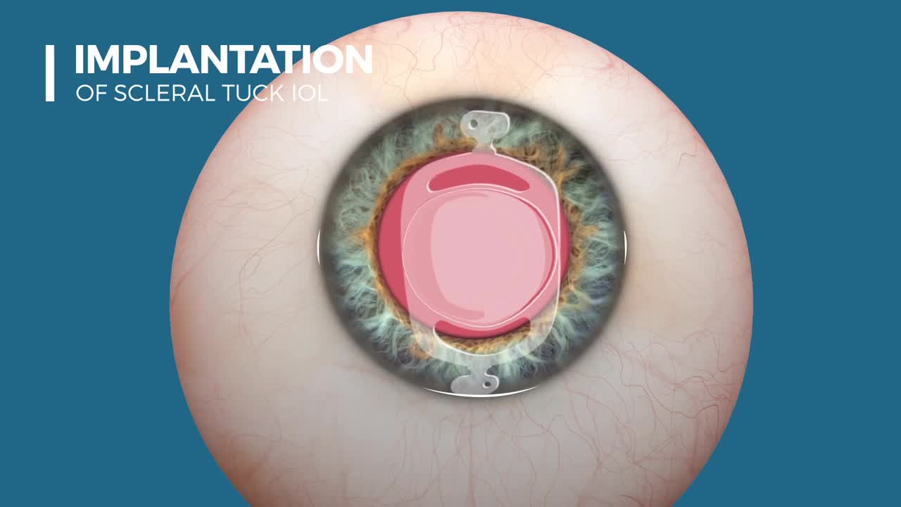 The Scleral Tuck IOL