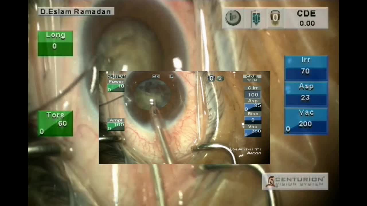 Centurion Versus Infiniti in a Hard Cataract