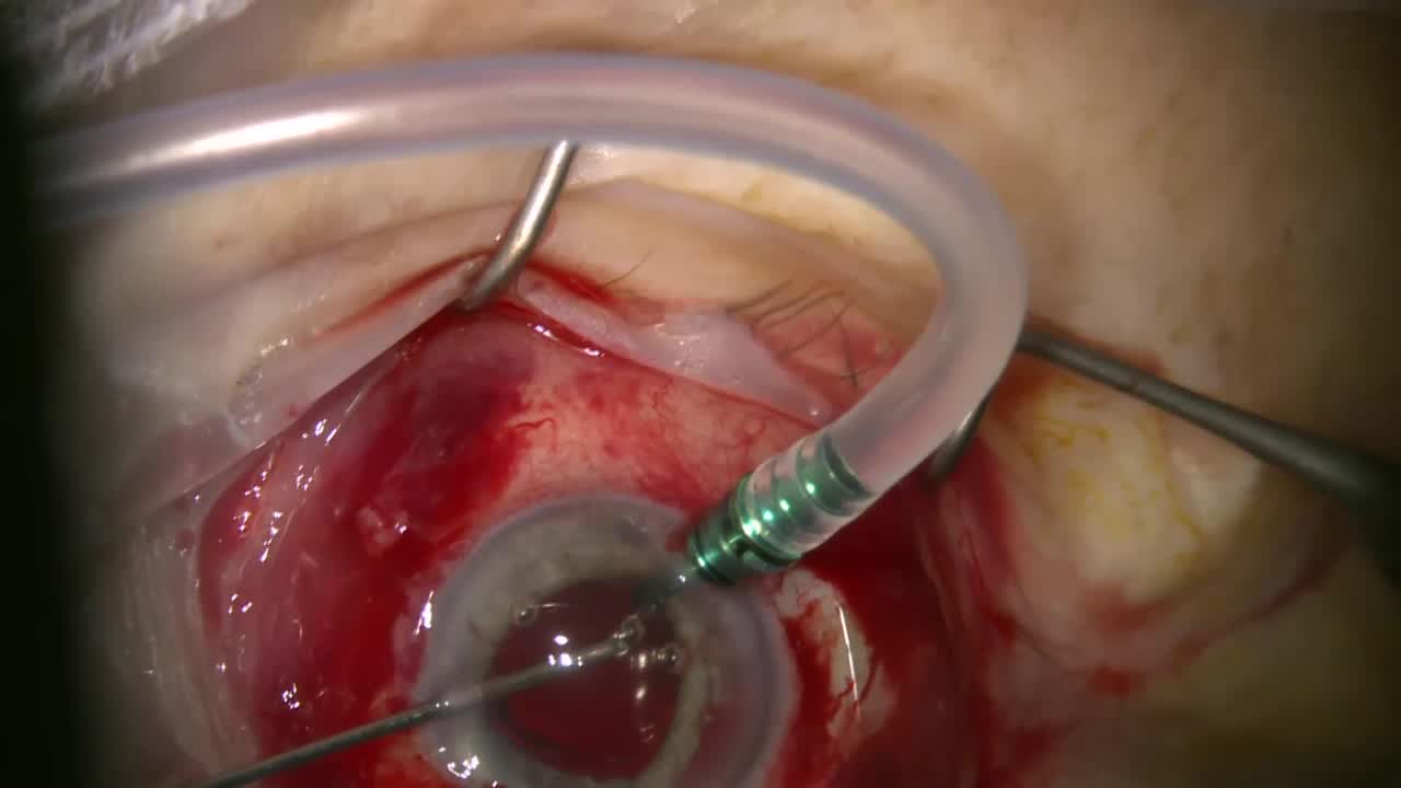 UGH...ACIOL Nightmare Again