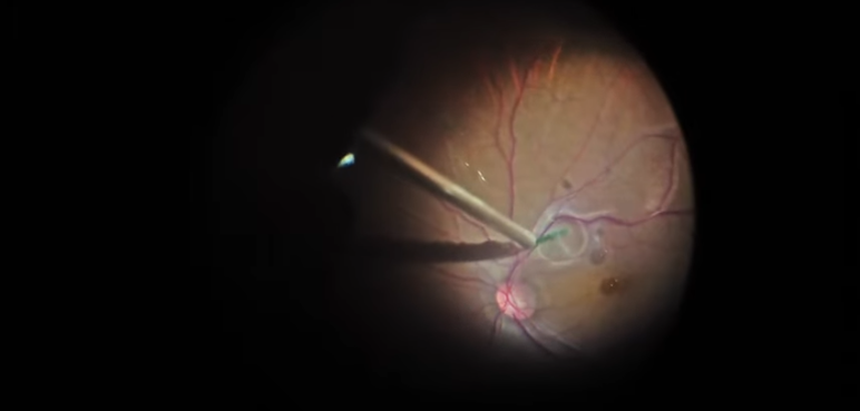 Subretinal Perfluorocarbon Removal With 38-Gauge Cannula TIp Under Silicon Oil