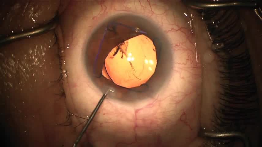 Malyugan Ring Insertion and Removal