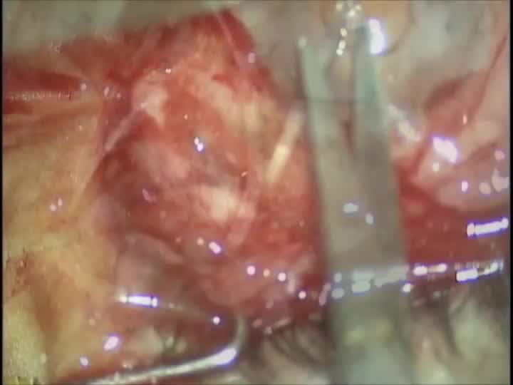 Keratoprosthesis Treatment of Corneal Blindness