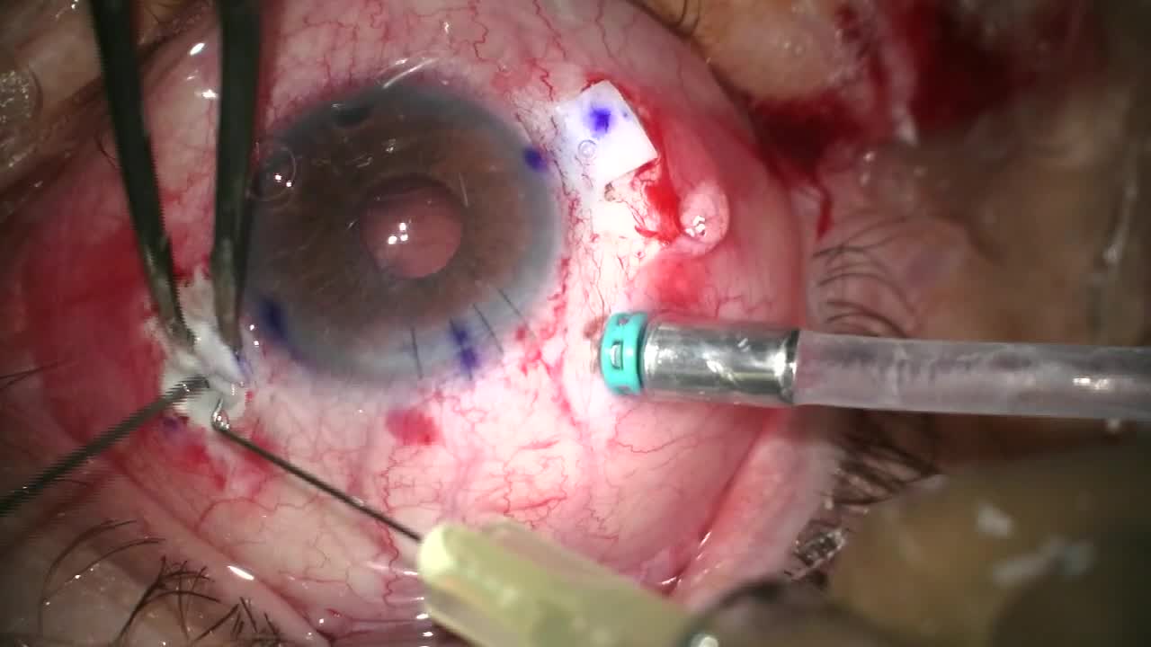 Combined Implantation of Carlevale FIL SSF IOL and Artificial Iris