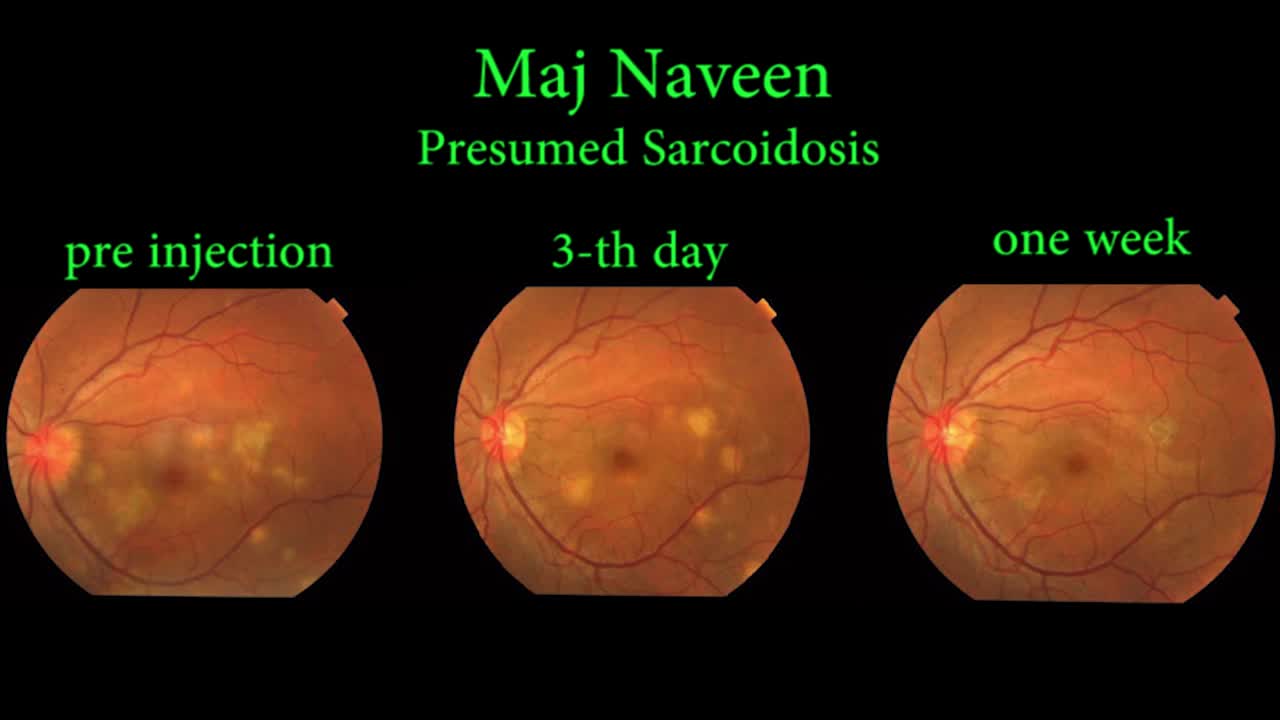 Mishev&Marashi SCS Needle for Suprachoroidal Drug Delivery: Technique and Early Results