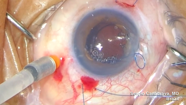 Step by Step: 4-Flanged Polypropylene Intrascleral Fixation