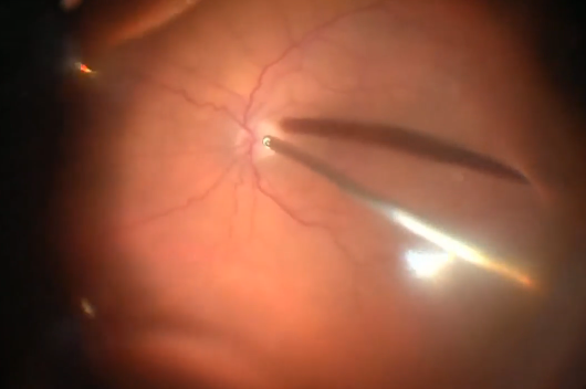 Anterior Lens Capsular Graft