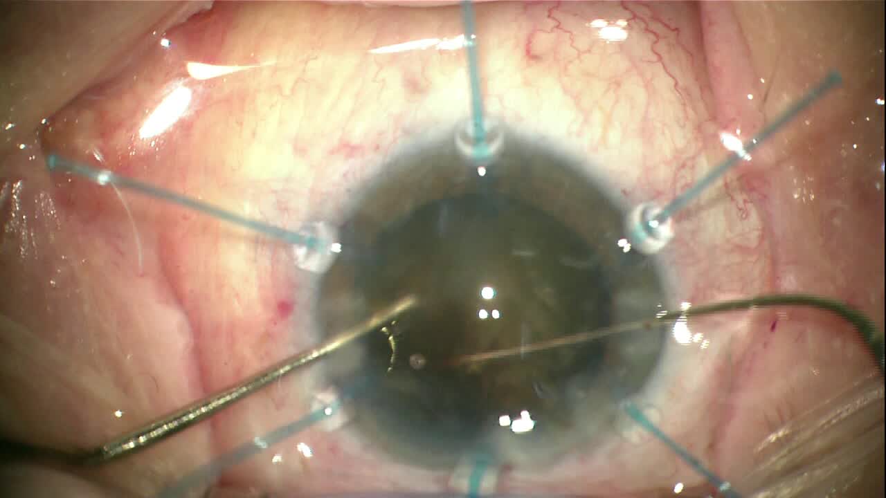 Black Cataract, No Vitreous, and Zonular Compromise