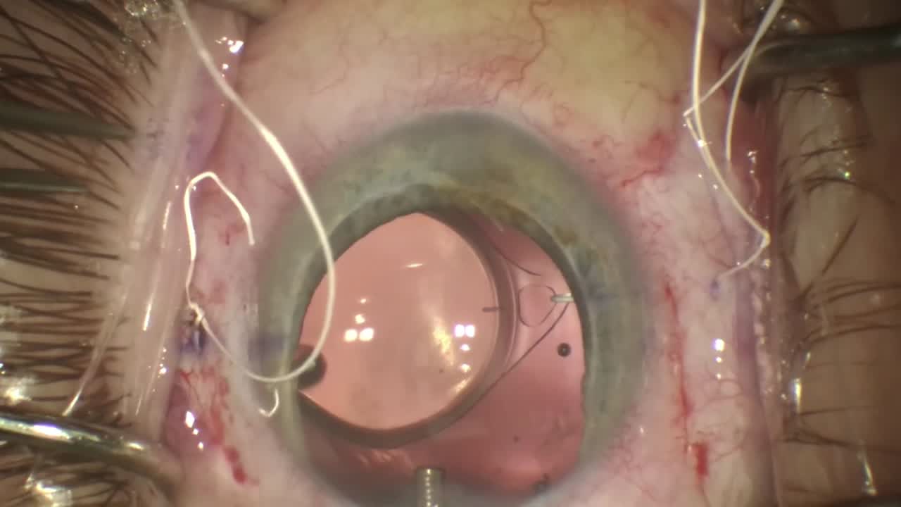 Gore-Tex Sutured enVista Toric IOL