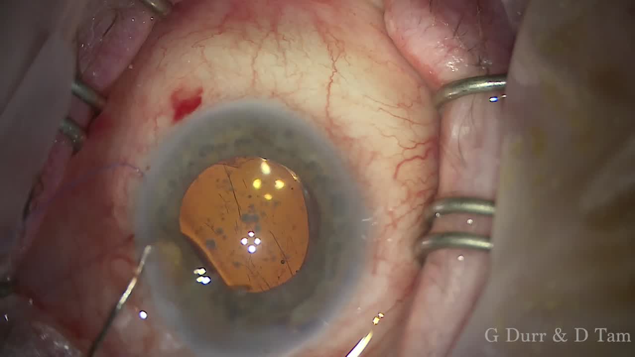 Xen Gel Stent With a Twist